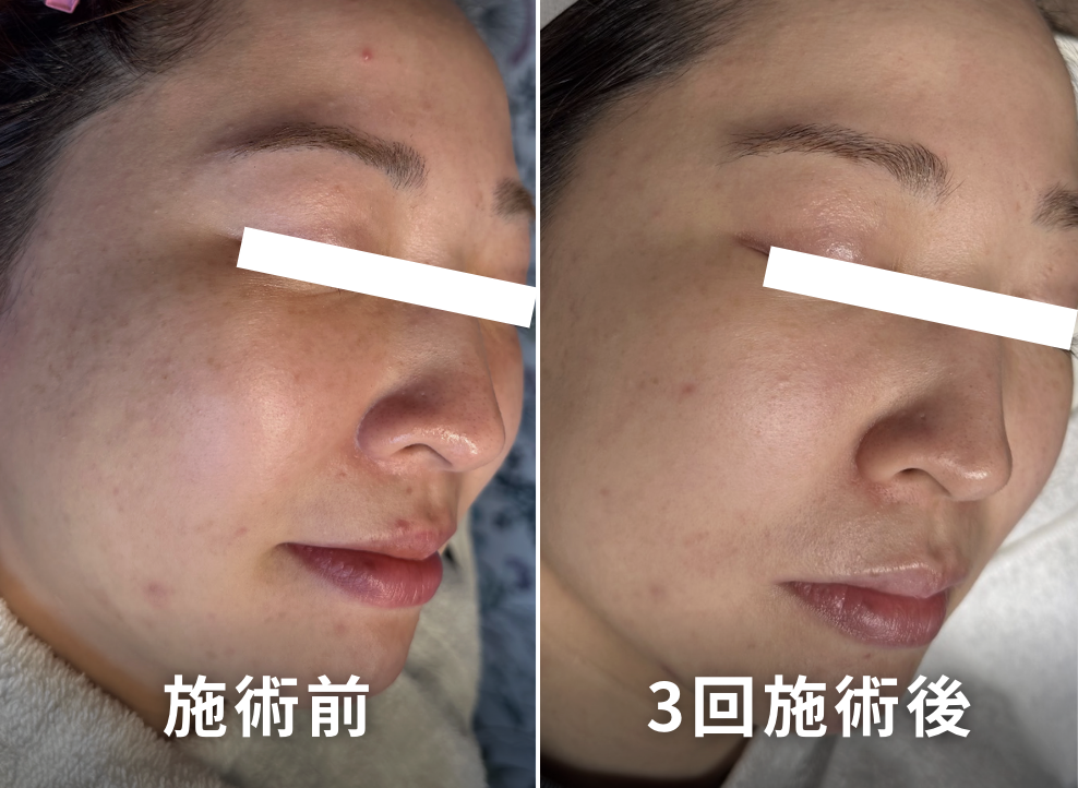 肌ビフォーアフター6