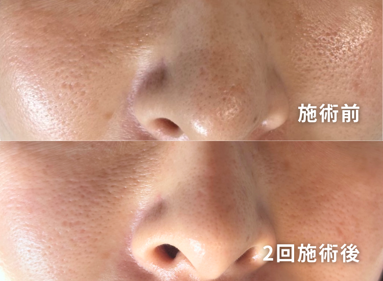 肌ビフォーアフター2