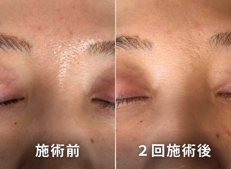 肌ビフォーアフター4