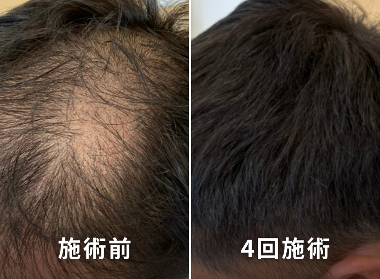 頭皮ビフォーアフター3