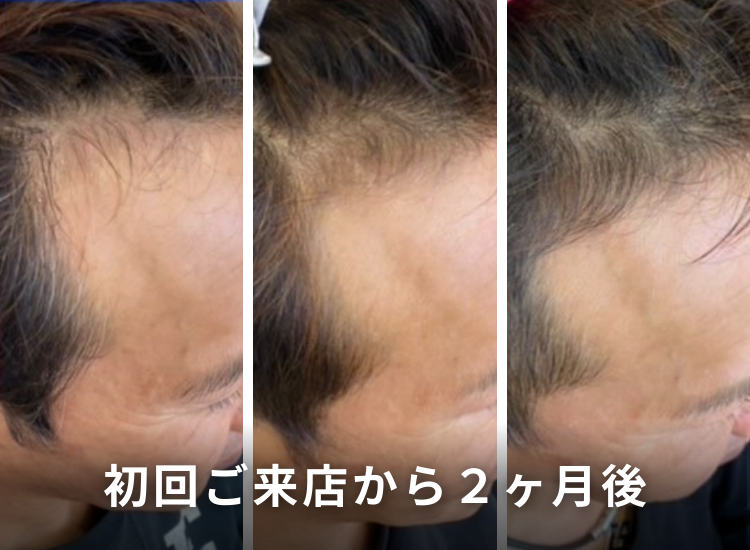 頭皮ビフォーアフター4